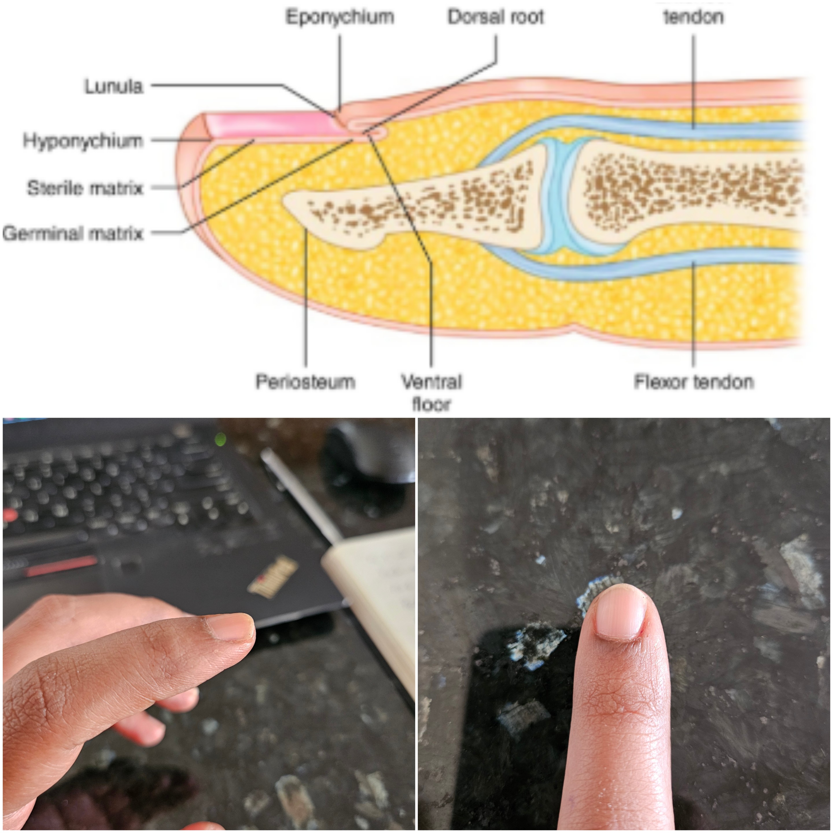 Lipoma