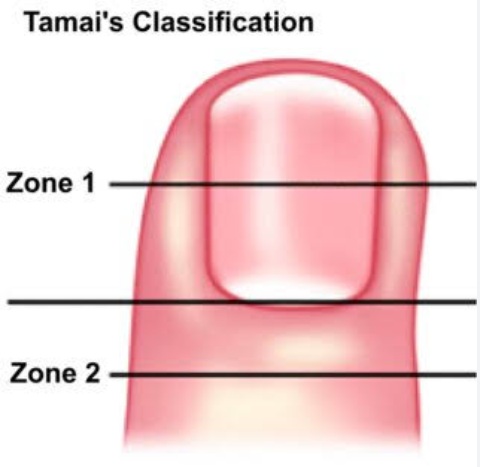 Lipoma