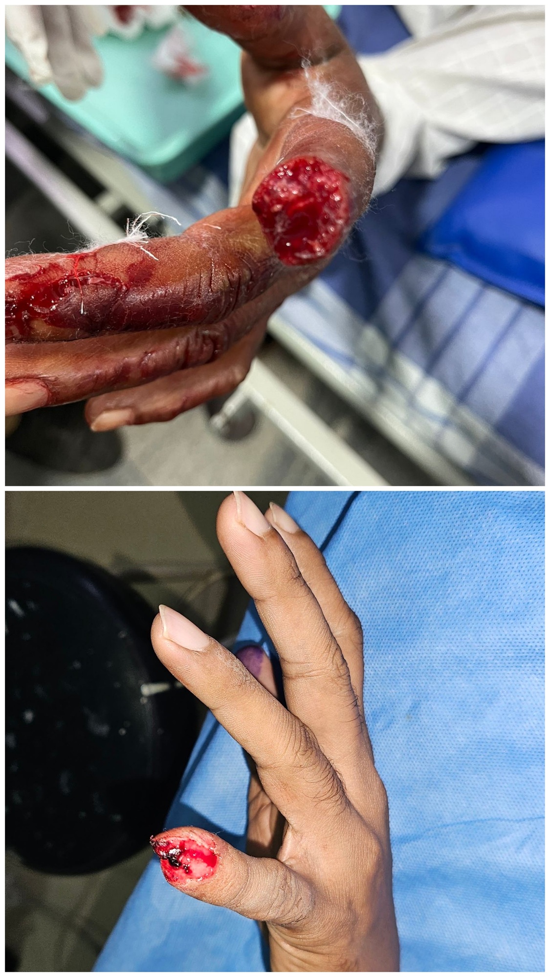 Lipoma