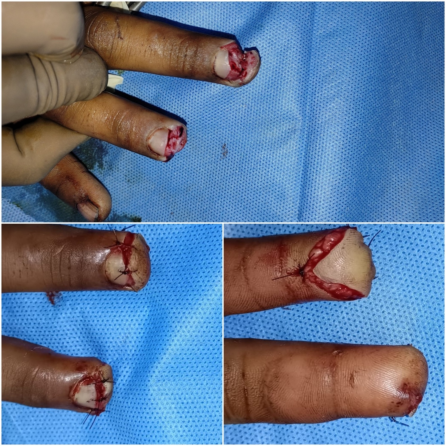Lipoma