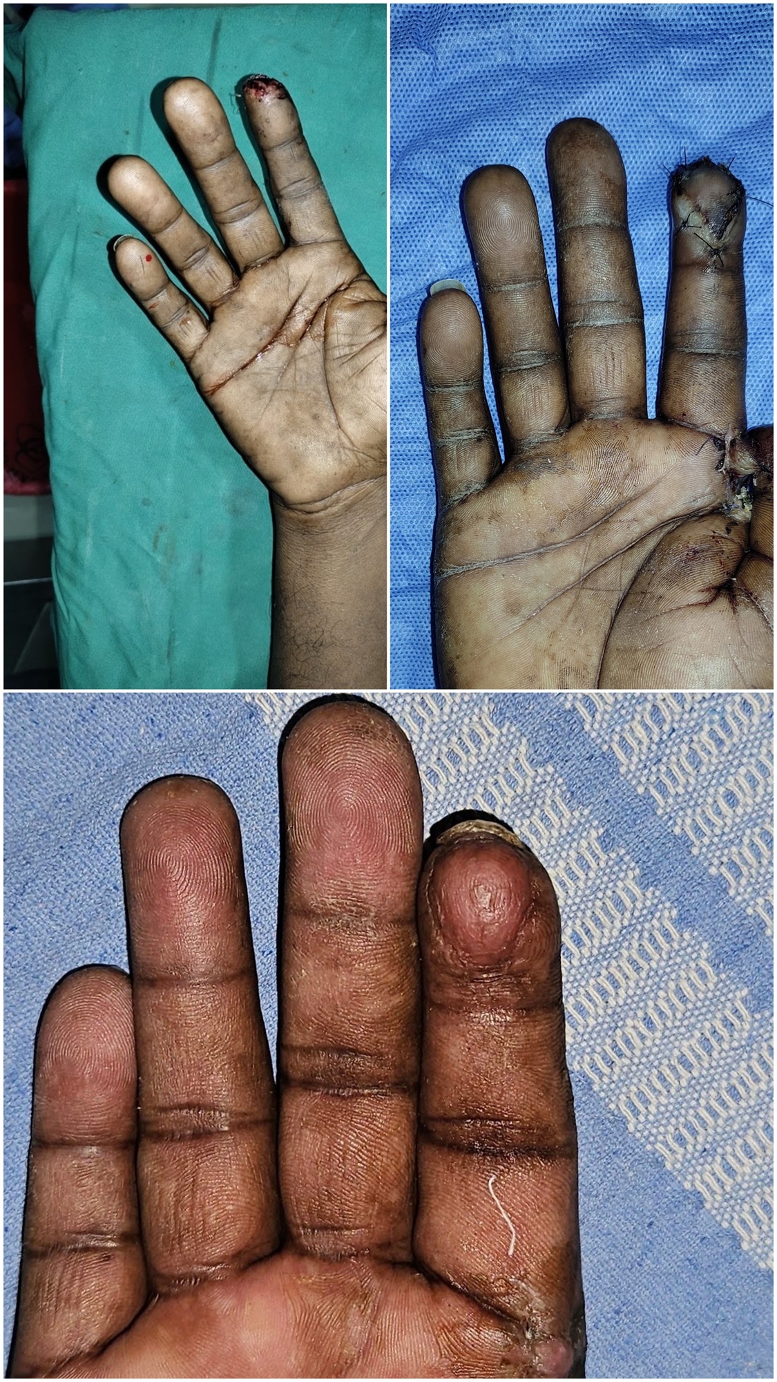 Lipoma