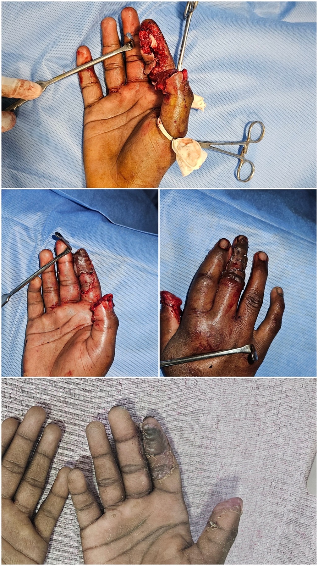 Lipoma
