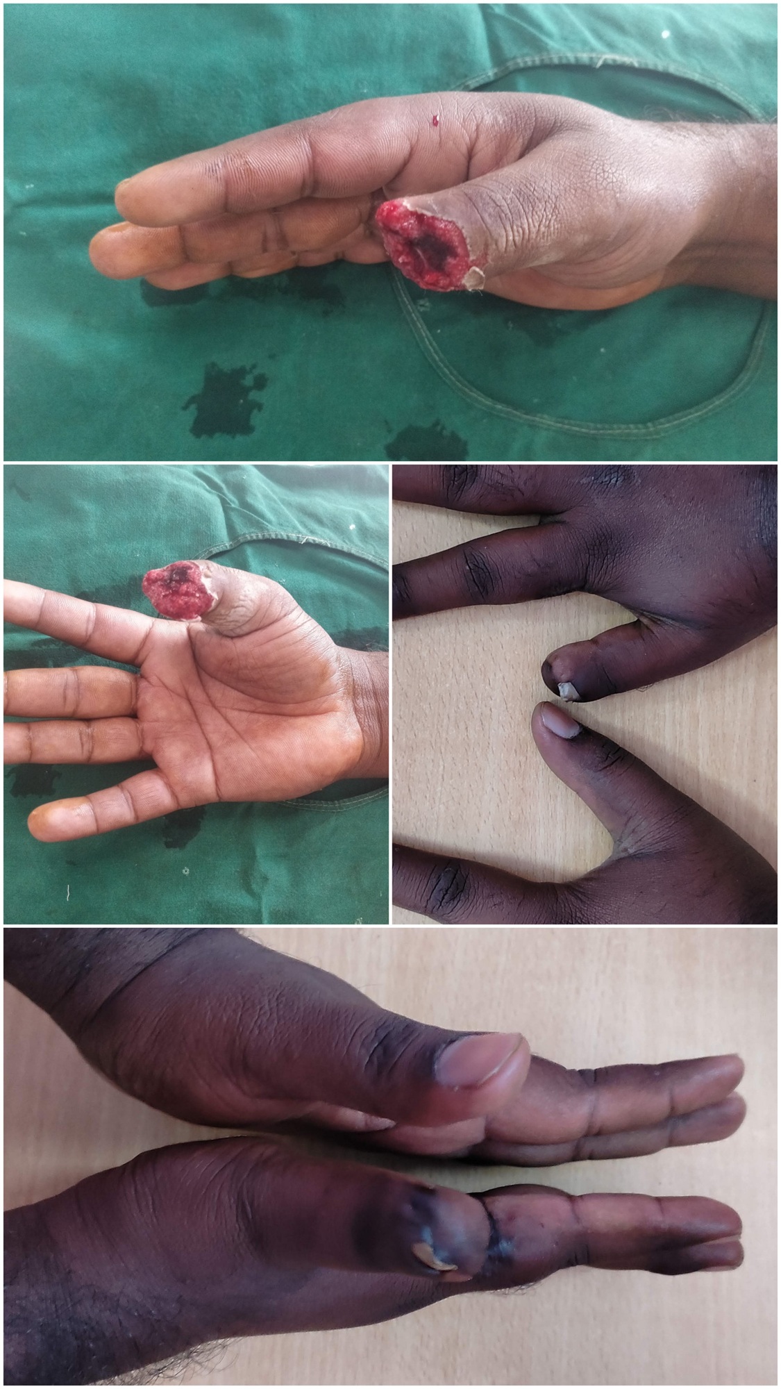 Lipoma