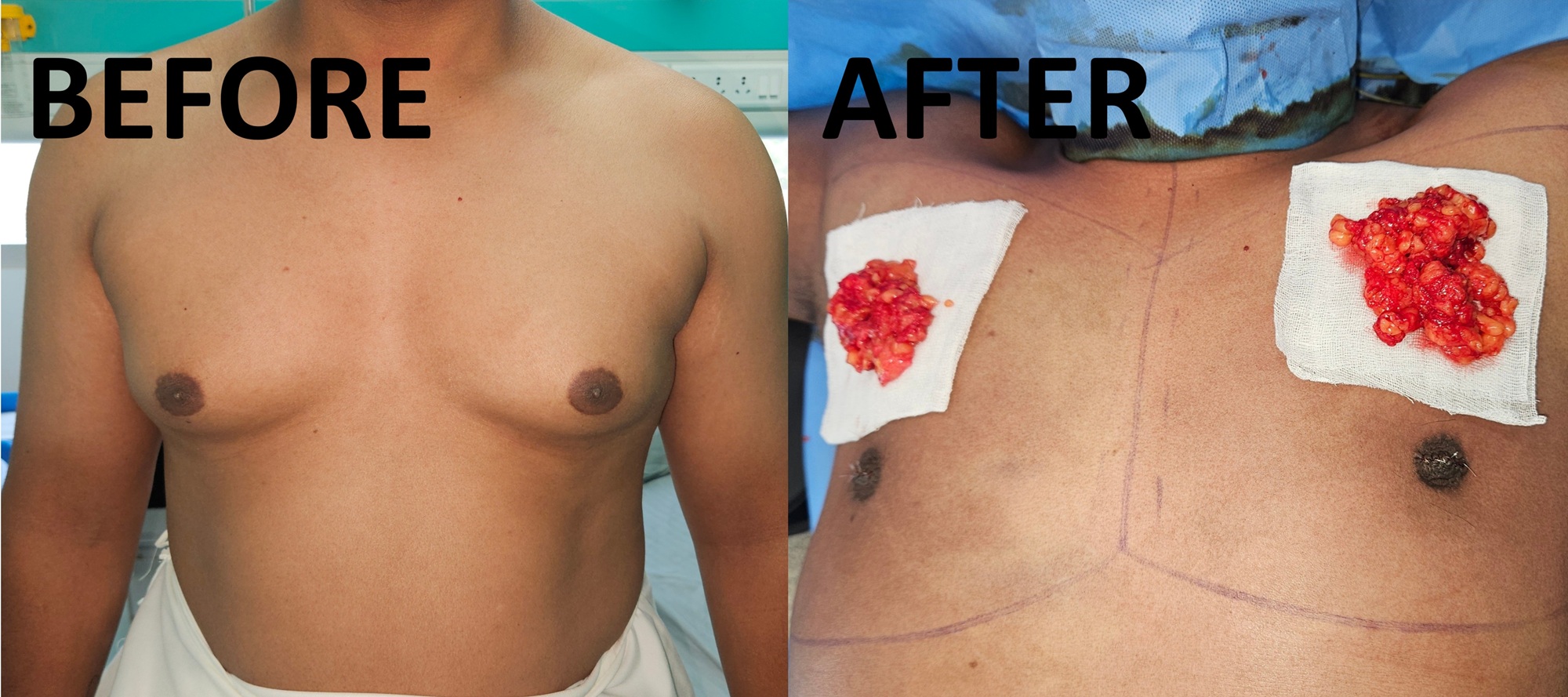 Gynaecomastia