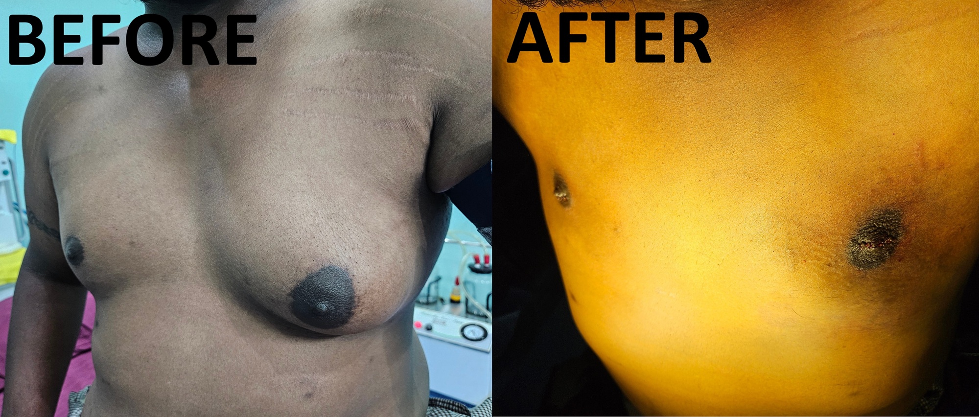 Gynaecomastia