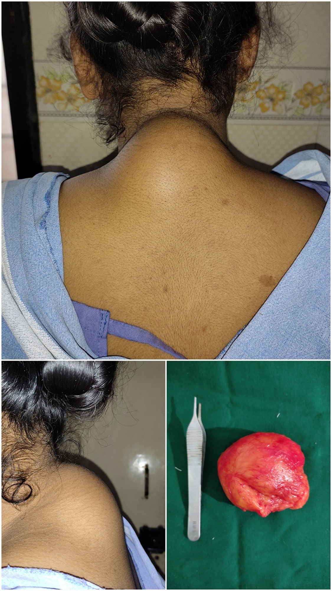 Lipoma