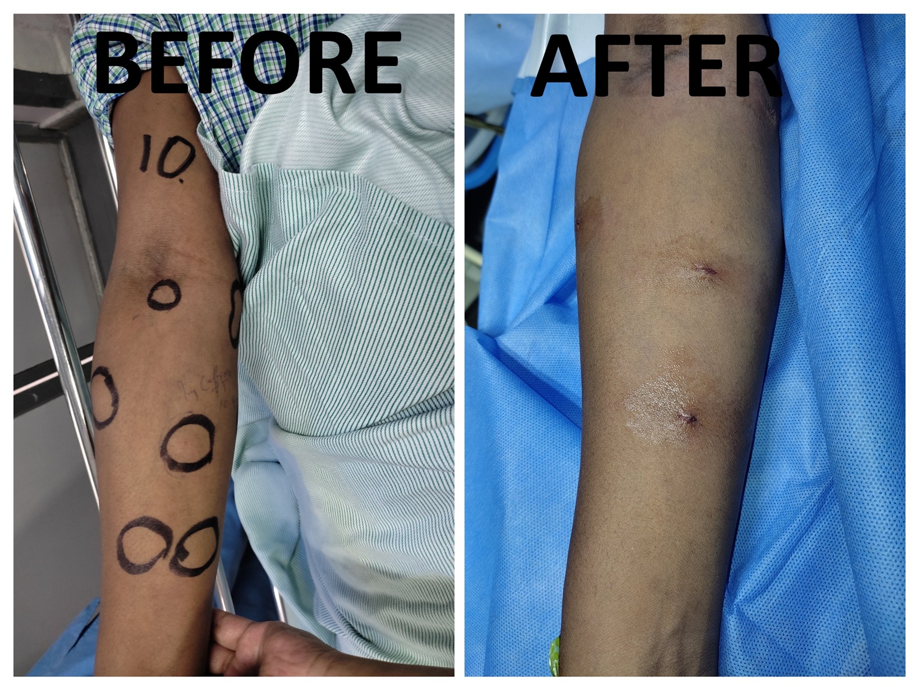 Lipoma