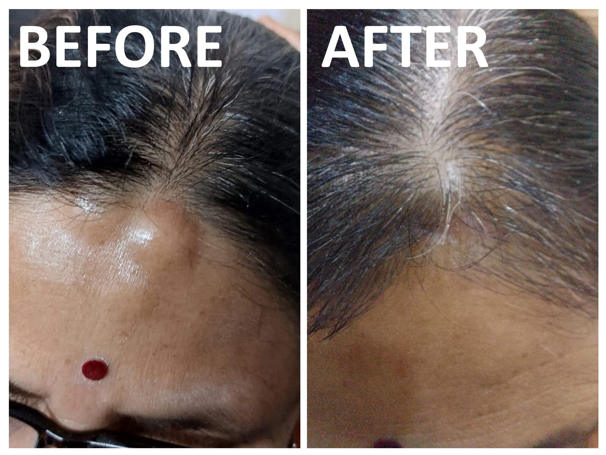 Lipoma