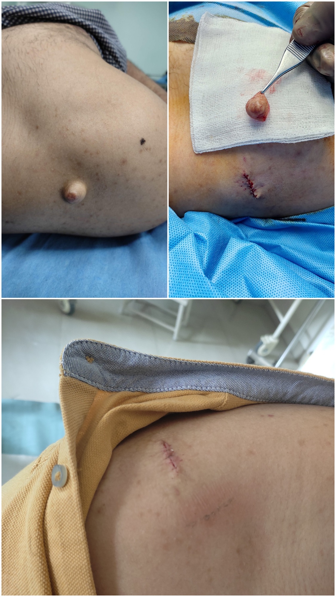 SebaceousCyst