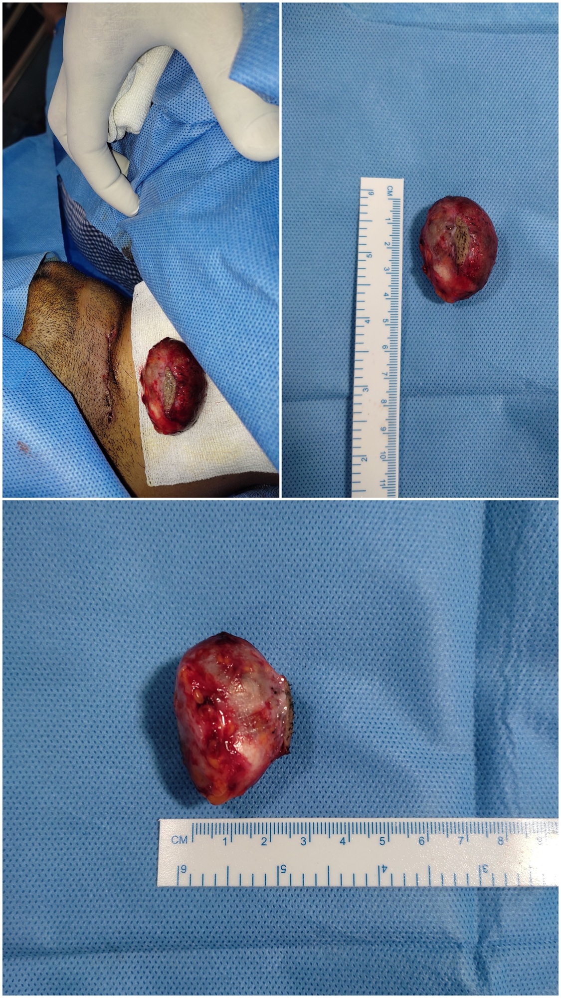 SebaceousCyst