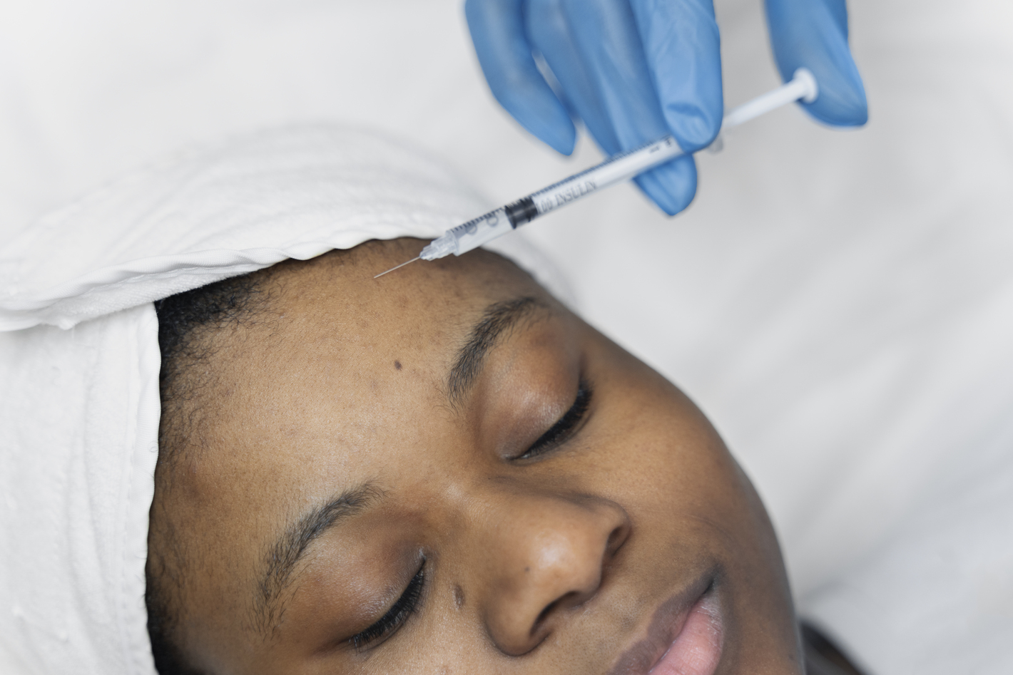person-getting-micro-needling-beauty-treatment (1)