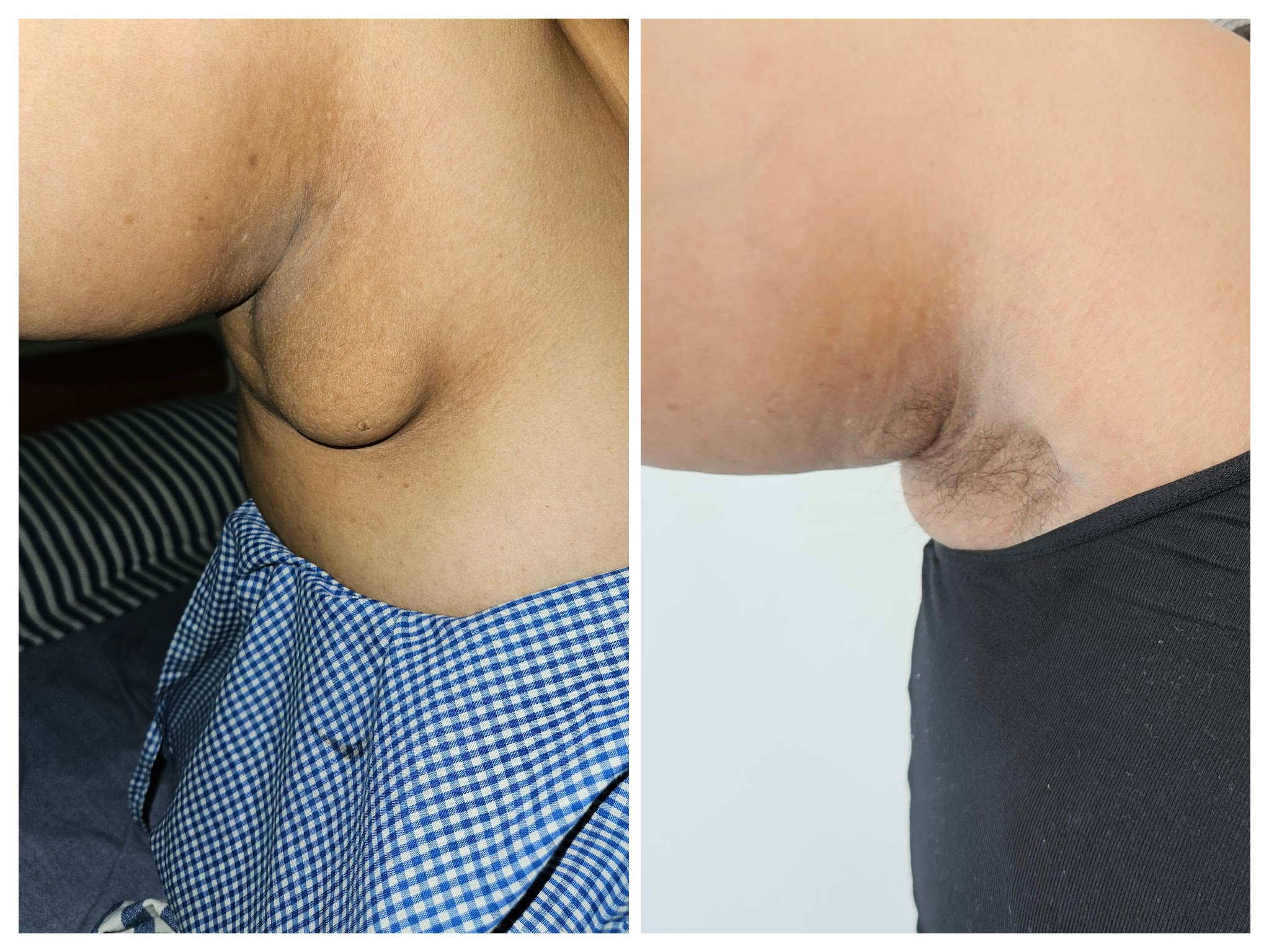 pic 2 breast